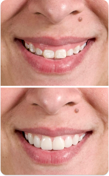 Close-up of a woman's teeth before treatment