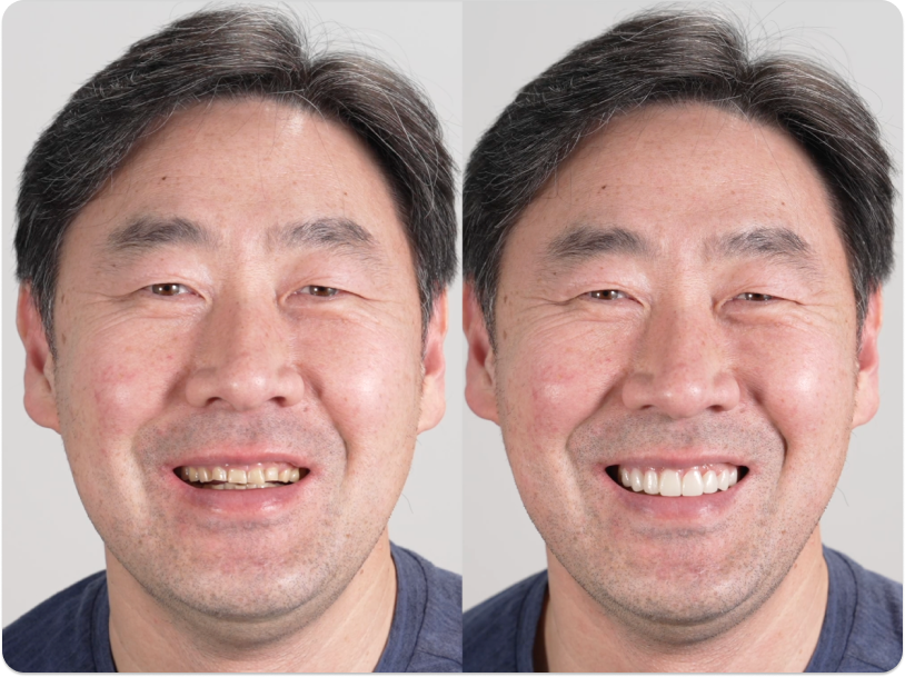 Before and after image of a man smiling