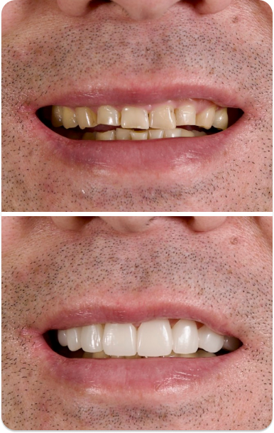 Close-up of a man's teeth before treatment